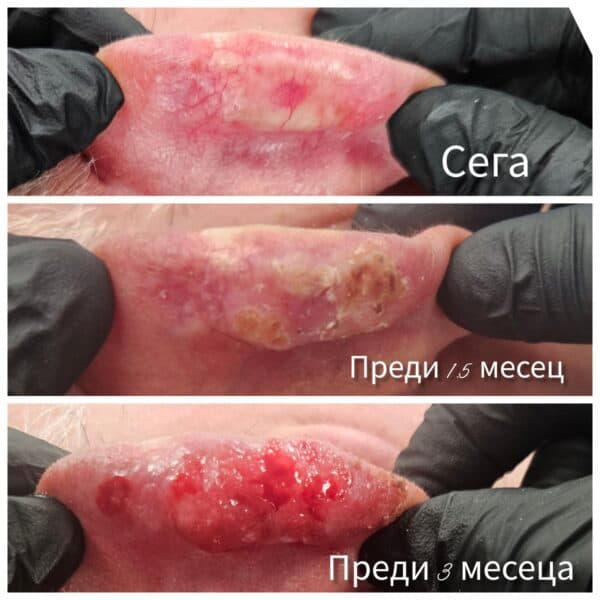 Dermatosurgery and basal cell carcinoma