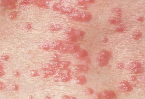 Viral warts – types and distribution on the skin