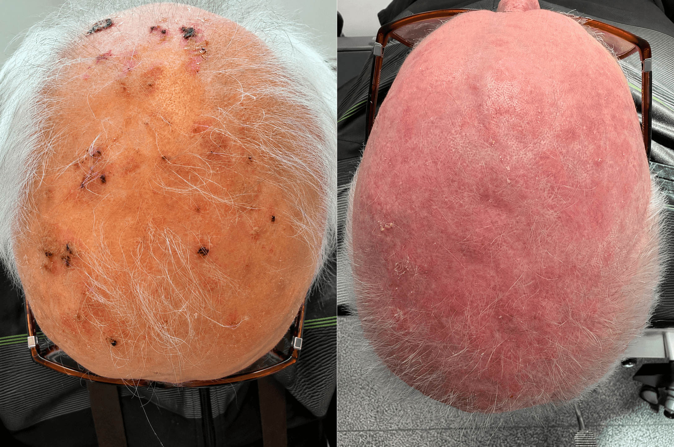 Actinic keratosis on the skin caused by long-term sun damage