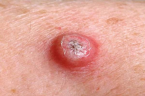 What is a keratoacanthoma