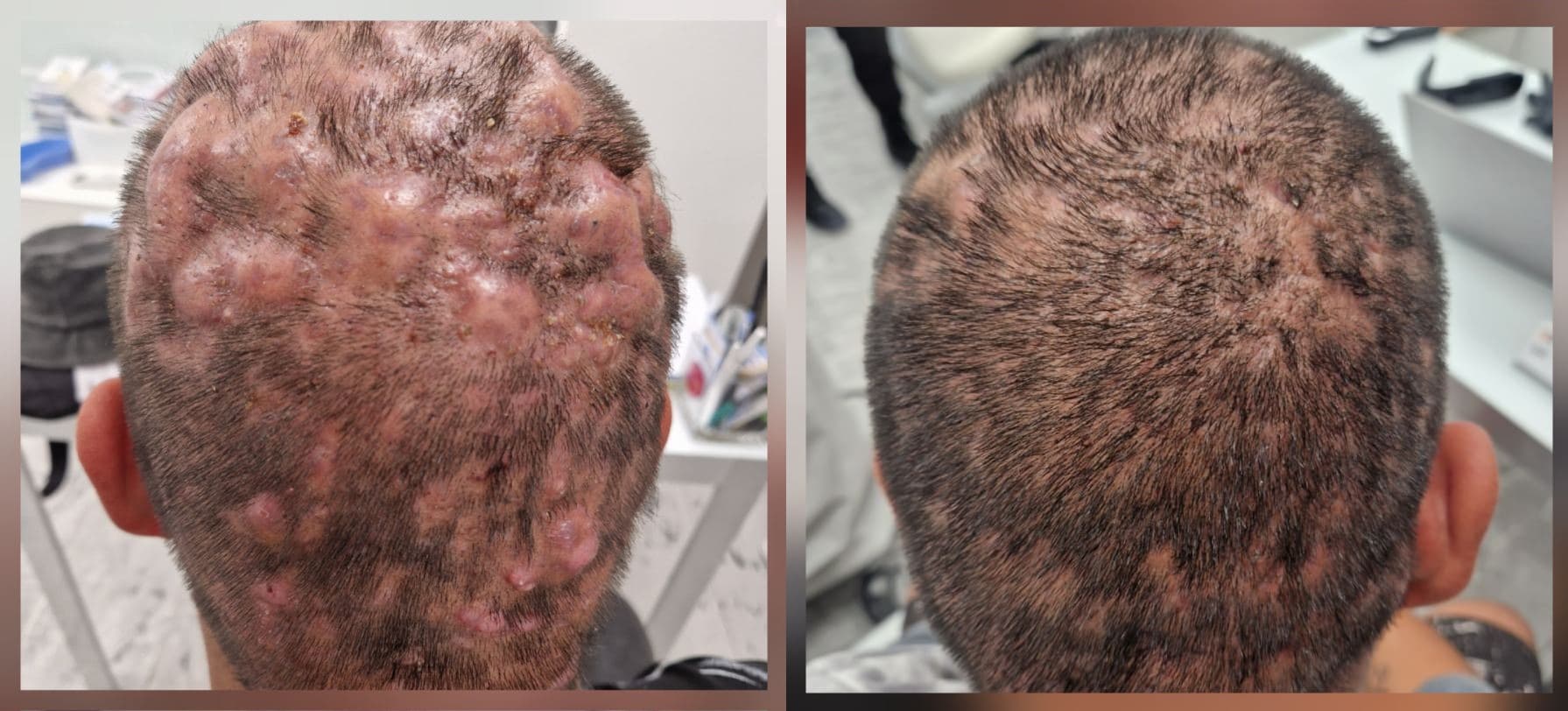 Dissecting cellulitis of the scalp – a rare inflammatory disease leading to...