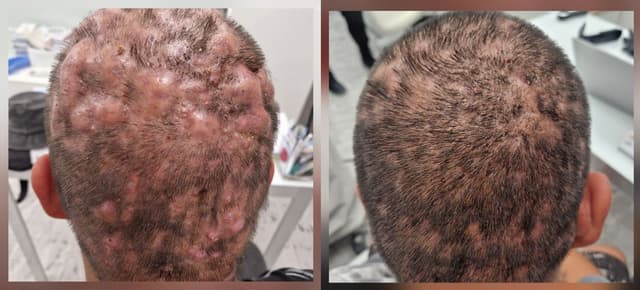 Dissecting cellulitis of the scalp – a rare inflammatory disease leading to...